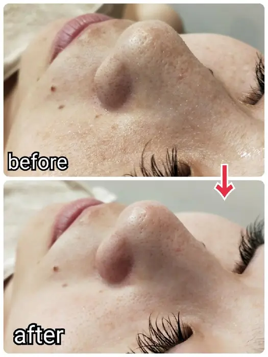 オイルアップ角栓除去ビフォーアフター Crebia クレビア 所属 Crebia クレビア オーナーのエステ リラクカタログ ミニモ