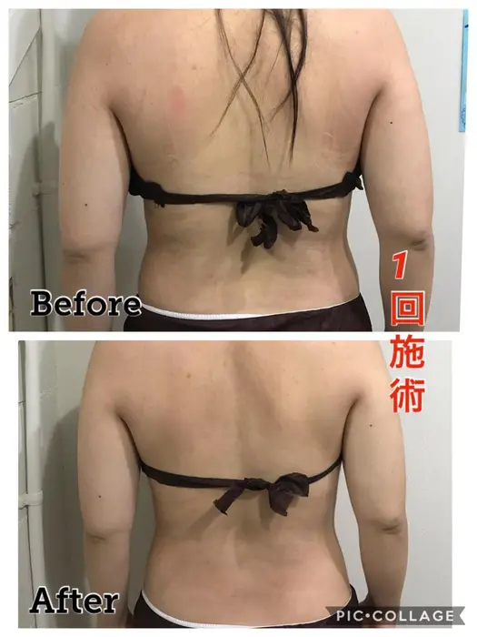 話題のエステ機器 ハイフ の特殊な超音波の熱を皮下脂肪に当て分解し柔らかくします 痛みがほとんどな ルリアン稲荷口所属 服部 衣里香のエステ リラクカタログ ミニモ