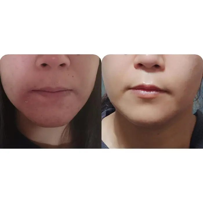 乾燥肌とニキビに悩んでいましたが １ヶ月で改善 今ではツヤツヤ ぷるぷるお肌を手に入れました 峰 真由美 スキンケア 痩身 所属 峰 真由美のヘアカタログ ミニモ