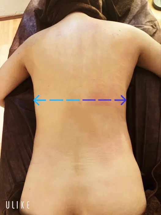 片側だけの施術結果 濃いブルーのライン 右側 を見るとお背中の幅が 狭くなってる Lily Passo所属 Lily Passoのエステ リラクカタログ ミニモ