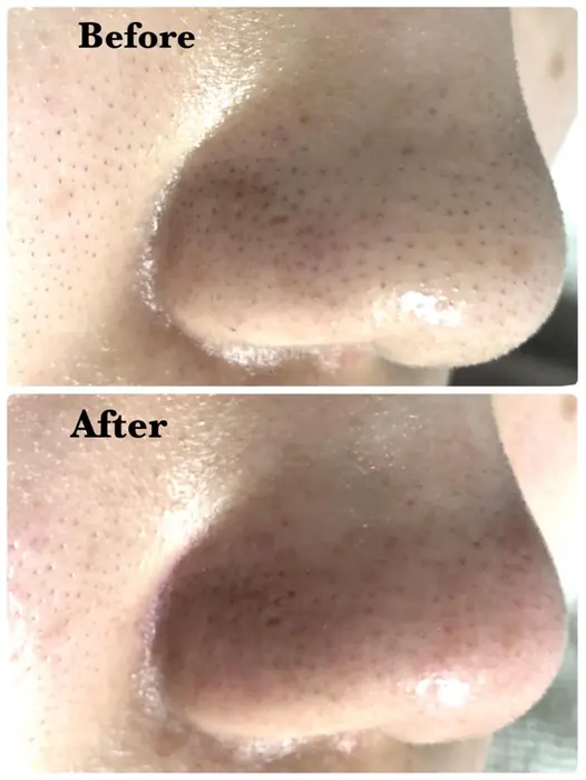 ハイドラフェイシャル 一回の効果です Laguna所属 Laguna ラグナ のエステ リラクカタログ ミニモ