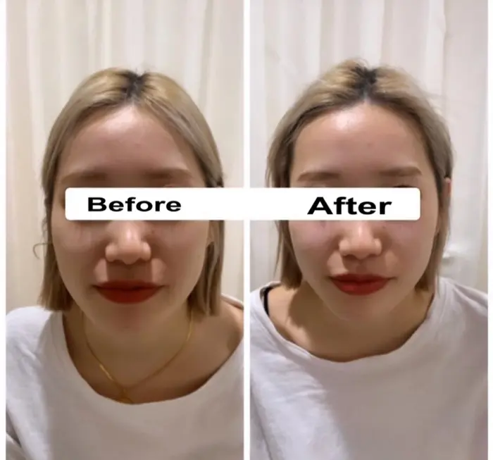 おでこのシワ薄くなります毛穴が引き締まるのでお肌も綺麗になります 秒速小顔所属 秒速小顔 東銀座店の エステ リラクカタログ ミニモ