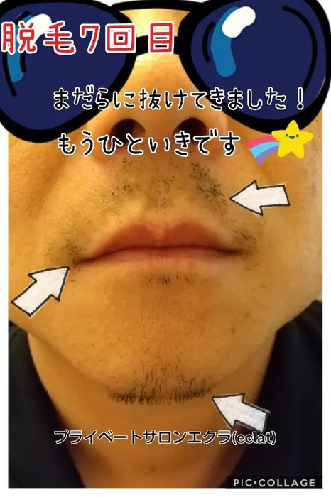 ひげ脱毛の途中経過です 頬は大分無くなりましたが 毛の濃い顎や鼻下はまだ残っています 脱毛を続けて行 メンズ脱毛サロン エクラ Eclat 所属 須藤 純世のエステ リラクカタログ ミニモ