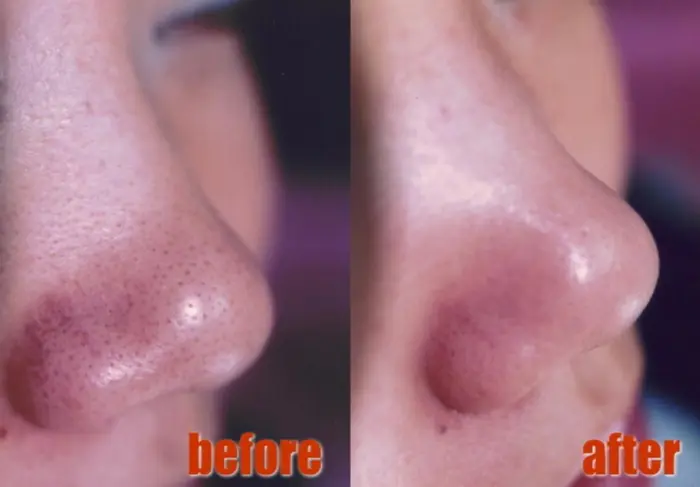 イチゴ鼻 毛穴の黒ずみキレイになります ツルツルピカピカ 女子力アップ トータルビューティーサロンソレイユ所属 バスト痩身美顔専門店 ソレイユのヘアカタログ ミニモ