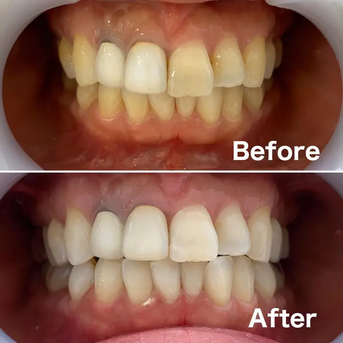 初回の方のビフォーアフターです 右上の2本が差し歯だったので そこのお色に合わせたいと言うことで ミュゼホワイトニングセルフ Beauty Boutique 東京駅前店所属 ミュゼホワイトニング セルフ 東京駅前店のヘアカタログ ミニモ