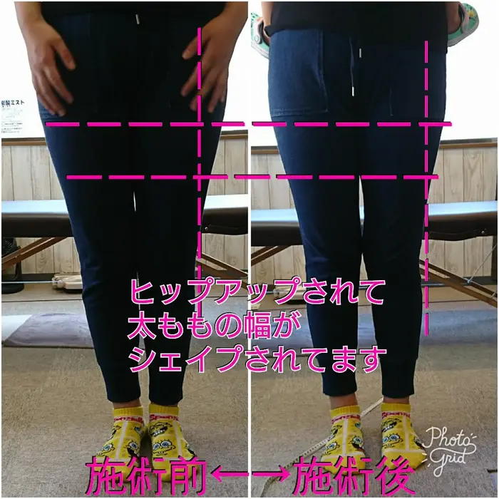 骨盤矯正 初回 太ももの出っ張りも骨盤のいがみの場合多いです ホワイトニング 骨盤矯正 ジュリアスラボ所属 山口 裕馨のヘアカタログ ミニモ 骨盤矯正 初回 太ももの出っ張りも骨盤のいがみの場合多いです ホワイトニング 骨盤矯正 ジュリアスラボ所属 山口 裕馨のヘアカタログ ミニモ