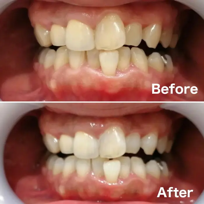 セルフホワイトニングのビフォーアフターのお写真です 1日でこの白さになりました ミュゼホワイトニングセルフ Beauty Boutique 東京駅前店所属 ミュゼホワイトニング セルフ 東京駅前店のヘアカタログ ミニモ