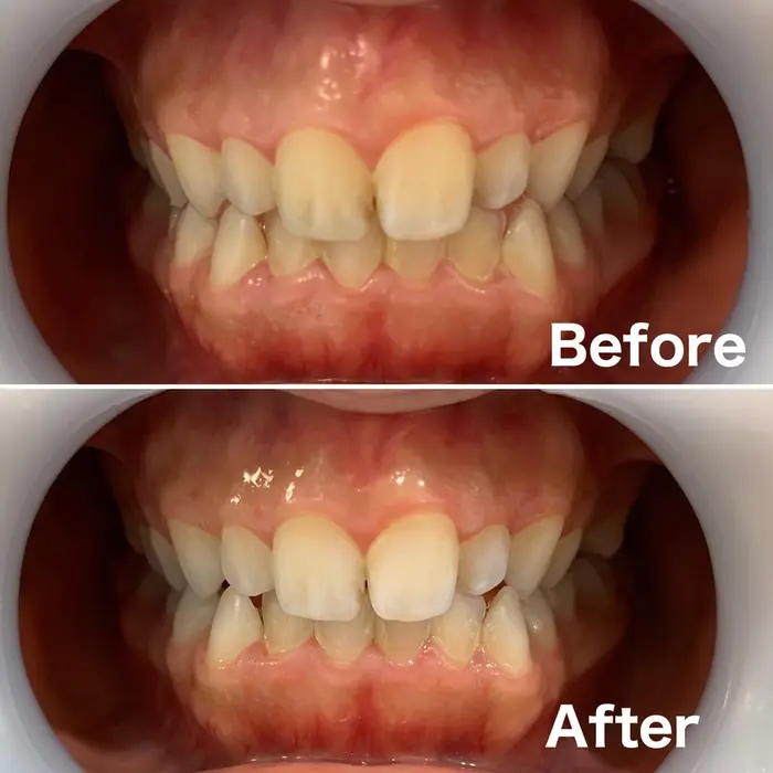 セルフホワイトニング8分 2回照射のビフォーアフターです 歯のトーンが1トーンでも上がるとお顔 ミュゼホワイトニングセルフ Beauty Boutique 東京駅前店所属 ミュゼホワイトニング セルフ 東京駅前店のヘアカタログ ミニモ