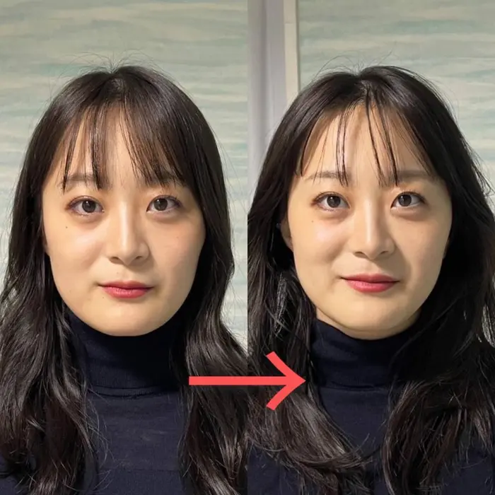 小顔矯正ビフォーアフター
目の開きが良くなり、顎周りがスッキリしまし...