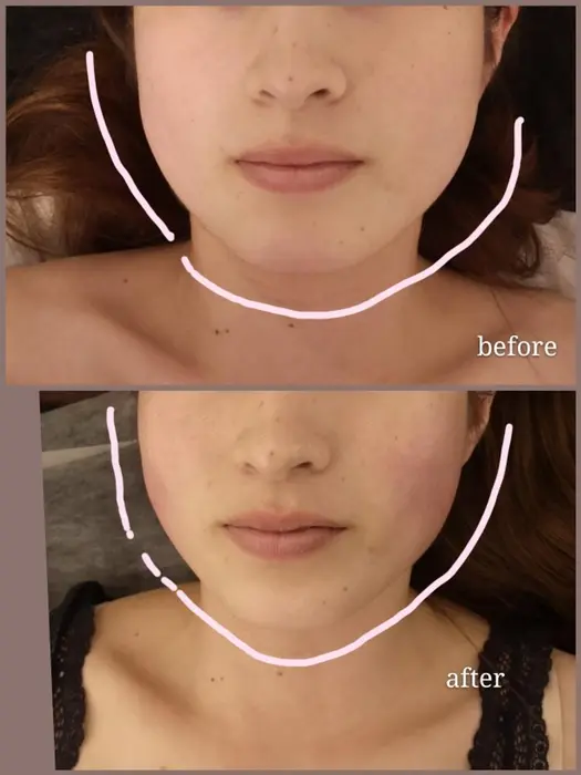 大人気小顔コース Facial 小顔への改善 肥大化したお顔の脂肪球への アプロ Guzel Salon所属 Guzel Safのエステ リラクカタログ ミニモ