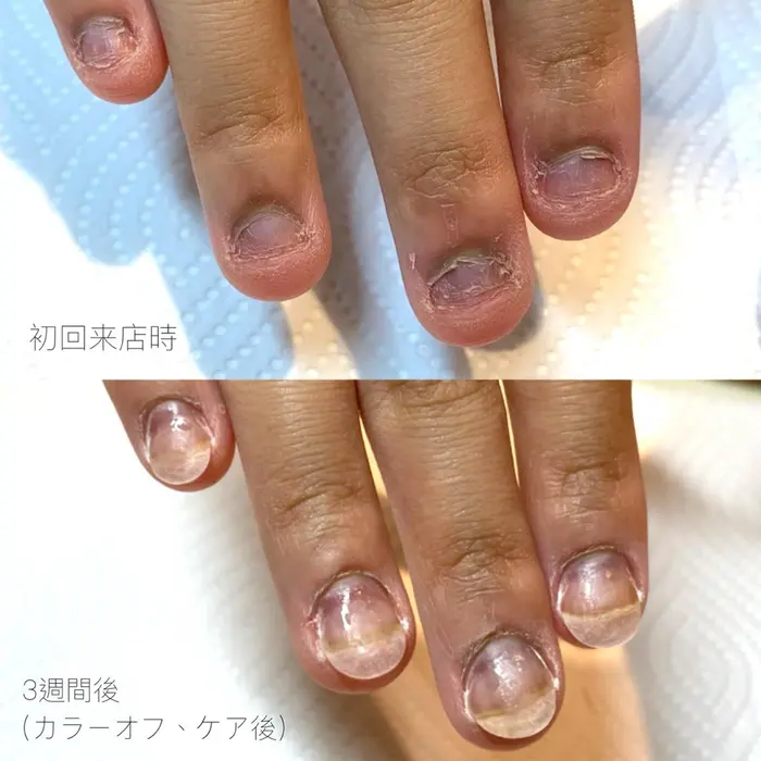 深爪矯正2回目 フィルイン施術 アメリ カシェット所属 Y Maikaのネイルデザイン ミニモ