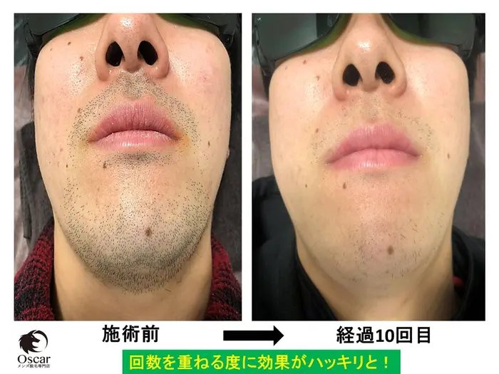 Oscar オスカー メンズ脱毛名古屋 髭 ヒゲ脱毛 男性脱毛 Vio脱毛 全身脱毛 永久脱毛 光脱 メンズ脱毛専門店oscar オスカー 所属 鈴木 一輝 脱毛技能 士 カウンセラー のエステ リラクカタログ ミニモ