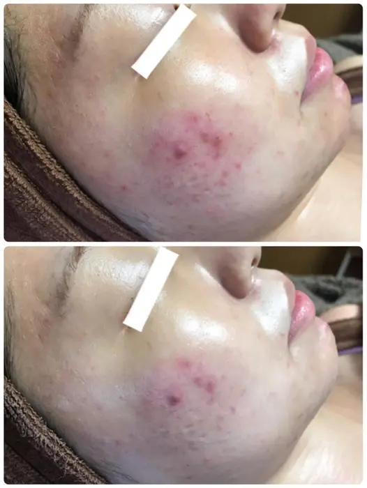 赤みにはシルクパウダーがオススメ マスクによる肌荒れにも お肌のキメを整え肌艶良くなります ハーブ専門dioneさいたま店所属 佐藤 えみのエステ リラクカタログ ミニモ