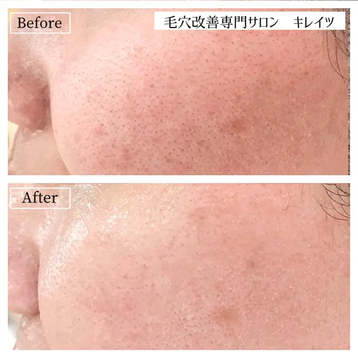 ぽっかりと開いた頬の毛穴一つとっても 原因はそれぞれ あなたに合った改善方法をご提案します Kireitsu所属 関 しずかのエステ リラクカタログ ミニモ