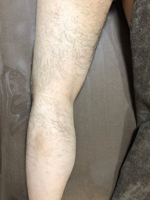 男性の足の脱毛 太もも裏って結構生えてます Pullulant所属 脱毛サロン Pullulantのエステ リラクカタログ ミニモ