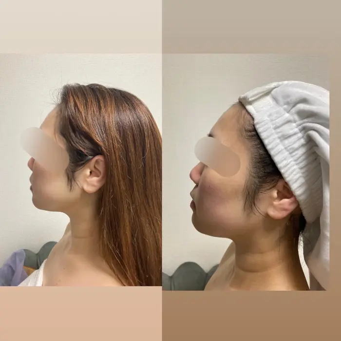 エステ版サーマクール900ショット 代後半女性 施術後の写真 ここから1 2ヶ月かけて更に引き締 Maldita Beauty Salon所属 シワ たるみ改善 専門店のエステ リラクカタログ ミニモ