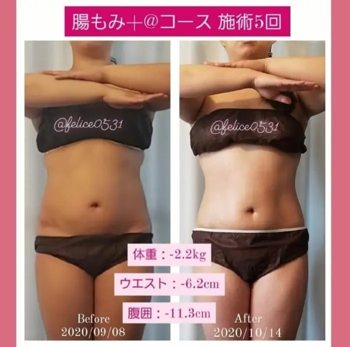 腸もみコース 5回 30代 週1ペースで5回通って下さったお客様です 3 7 日 間 顔と体の筋膜リリース専門店 Felice所属 腸もみ 筋膜リリース Felice のエステ リラクカタログ ミニモ