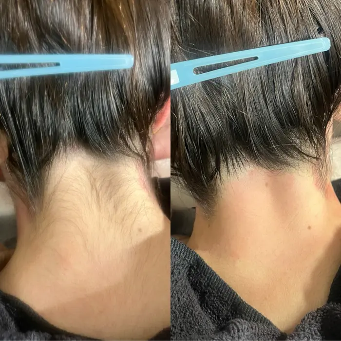 女性うなじワックス脱毛。注意事項あり