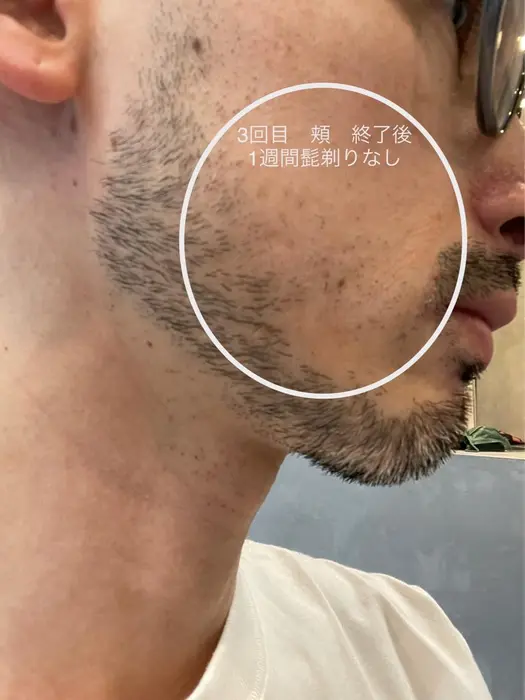 3回目の頬髭脱毛 メンズ脱毛 Barbermoku 光脱毛 所属 Barber Mokuのエステ リラクカタログ ミニモ