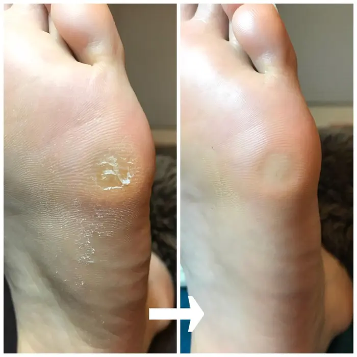 施術例 角質ケア60分 角質 タコ が内側入り込んでいます 魚の目で痛みが出る前の除去をお勧めいた Foot Fun フットファン 所属 Enomoto Yukoのヘアカタログ ミニモ