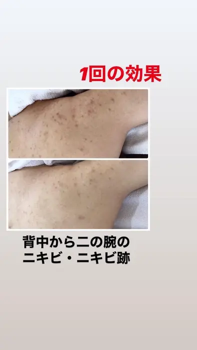 スキンプロサロン 大人ニキビ ニキビ跡 背中ニキビケア 所属 ハーブピーリング スキンプロサロンのエステ リラクカタログ ミニモ