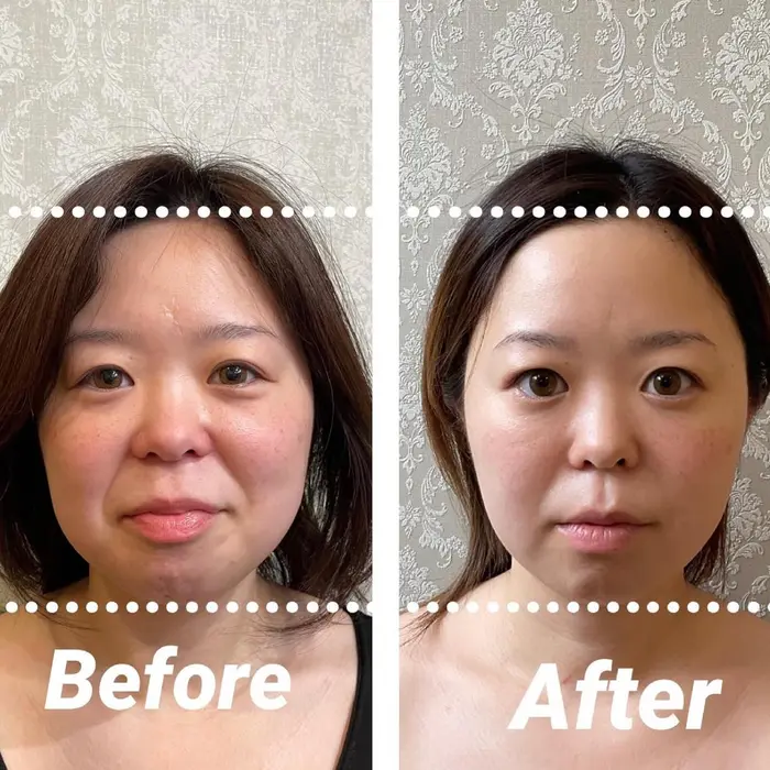 コルギ 最新小顔機械 2回 骨気 Relaxationvivian所属 宇佐美 みくのエステ リラクカタログ ミニモ