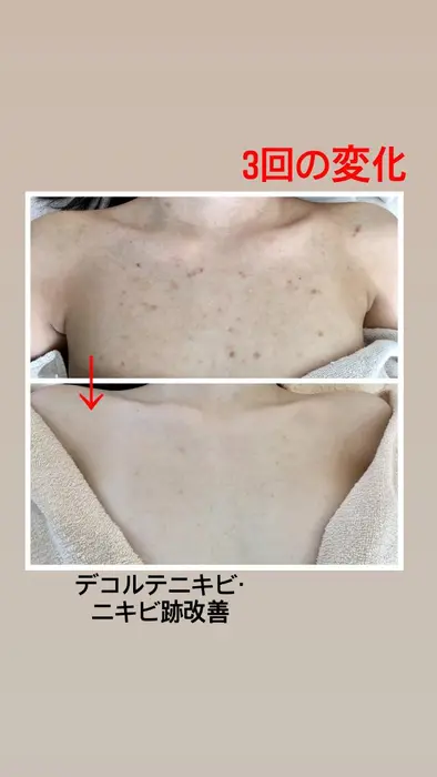 スキンプロサロン所属 背中ニキビ改善 スキンプロサロンのエステ リラクカタログ ミニモ