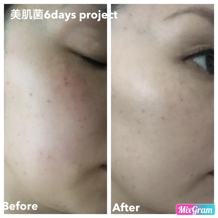 加工なし ファンデ無しでの美肌菌補給 終了までの前後です 6日間のみ集中プログラム 摩耗肌の毛 溝の口プライベートエステ Ranan所属 三浦 智子のエステ リラクカタログ ミニモ