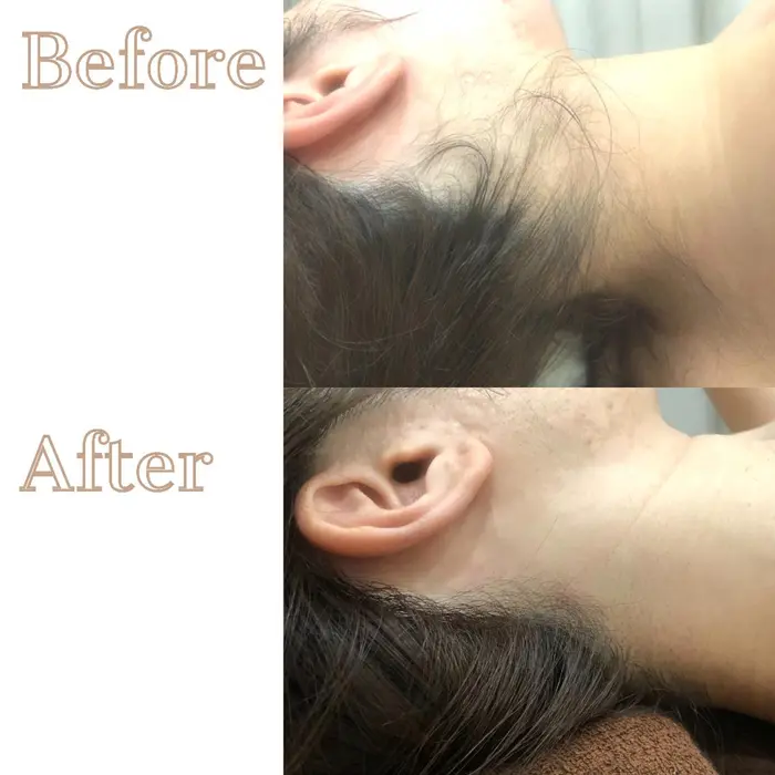 人気のうなじ脱毛 自分では見えない部分 意外とそのから見ると 気になる部分です うなじを ハイフエステサロンlaluna所属 Laluna マナミのエステ リラクカタログ ミニモ