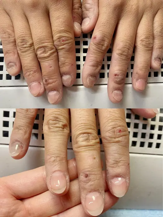 噛爪の方 長さ出し10本 小指は凹陥爪 補強2本 Q Free Nail Salon所属 ٩ Q F Ree وのネイル デザイン ミニモ