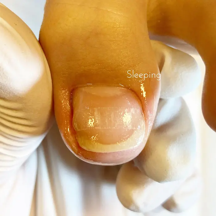 巻き爪でお困りの方へ 巻き爪矯正 巻き爪ケア ビーエスプラス ーーーーーーーーーー フットケアサロンすりーぴんぐ所属 しお のネイルデザイン ミニモ