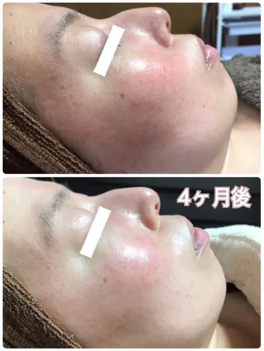 お顔の赤みがお悩みだったお客様 4ヶ月でこんなに変わりました どちらも来店時お手入れ前のお写真 ハーブ専門dioneさいたま店所属 佐藤 えみのエステ リラクカタログ ミニモ