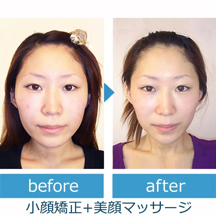 反論者 機械的に ビーチ 小 顔 矯正 マッサージ 同じ オレンジ 適合