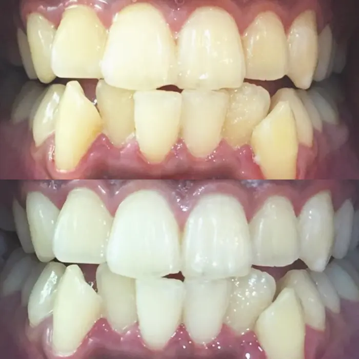 綺麗な歯になると 第一印象は確実にupします Lbsホワイトニング 恵比寿店所属 女性人気no 1 店長熊倉のエステ リラクカタログ ミニモ