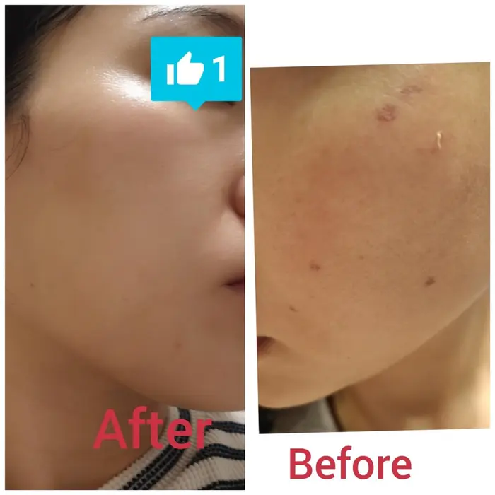 シミケア 剥離はシミケアしてから3日目 プラス肌が元気ない時は表面にだけ美容液ぬってもバツ 肌細胞が Guzel Salon所属 Guzel Safのエステ リラクカタログ ミニモ