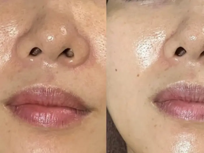 ＊次回予約-¥500＊韓国で話題の最強ピーリング！皮脂・乾燥ケア、エイジ?...