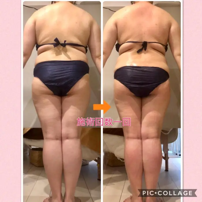 肩の盛り上がり 腰回りのハミ肉がなくなってスッキリされました お尻と裏もものセルライトも目立た Meguru所属 痩身専門エステ 結果出し丹野のエステ リラクカタログ ミニモ