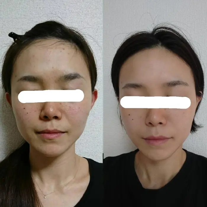 美肌改善しませんか シミ たるみ 肌荒れ ニキビ 赤ら顔 ひとつひとつ原因をさぐり改善いたしました プレボヌ Plebonu所属 プレボヌ Plebonuのエステ リラクカタログ ミニモ