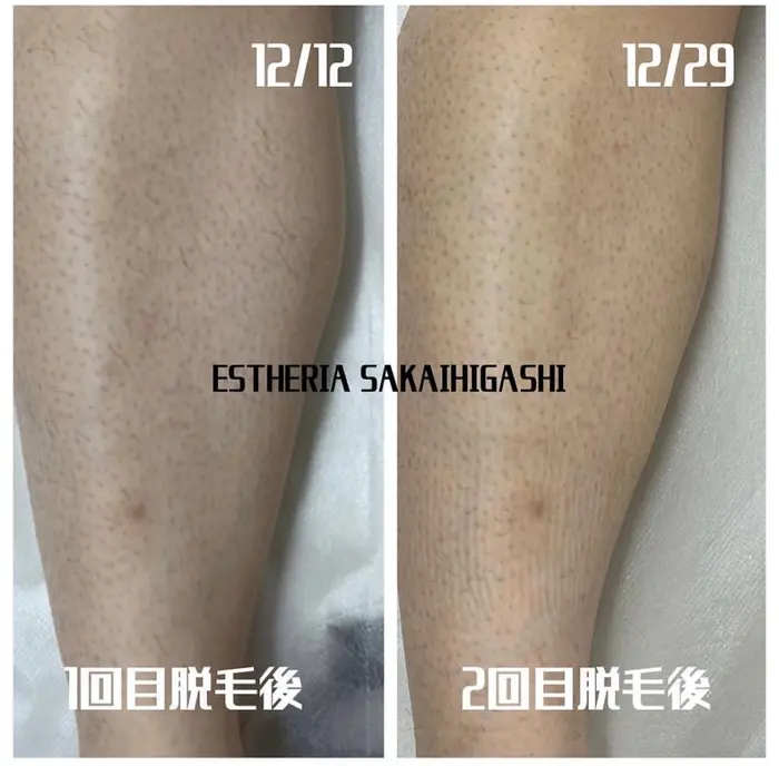 脚脱毛メンズ様 2回目 生え方がまばらになり毛量が少なくなっています 都度払い制脱毛 ハイフサロン エステリア堺東店所属 脱毛 ハイフサロン エステリア堺東店太田のエステ リラクカタログ ミニモ