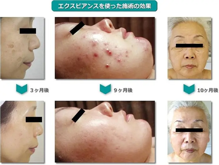 エクスビアンスのニキビケア Vida整体院所属 Vida整体院 のエステ リラクカタログ ミニモ