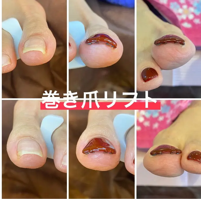 巻き爪リフト 巻き爪 巻き爪ジェルネイル Magenta所属 Mgenta Nail 巻き爪のネイルデザイン ミニモ 巻き爪リフト 巻き爪 巻き爪ジェルネイル Magenta所属 Mgenta Nail 巻き爪のネイルデザイン ミニモ