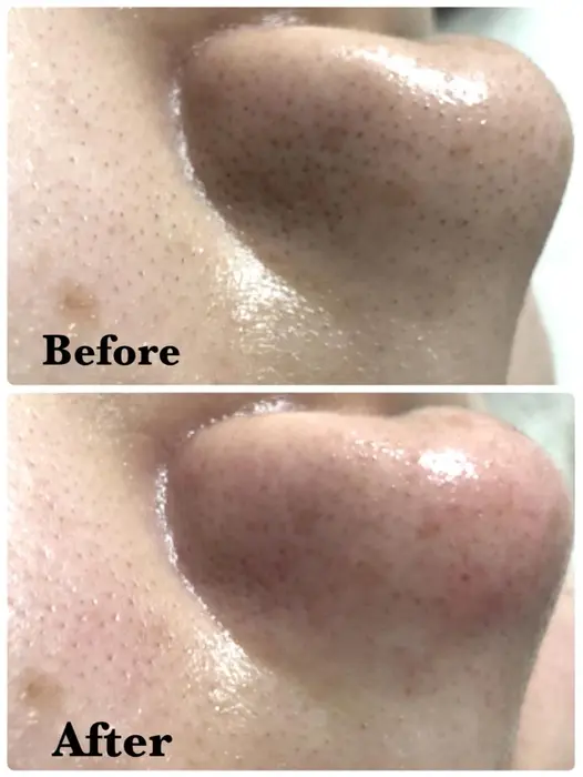 ハイドラフェイシャル 一回の効果です Laguna所属 Laguna ラグナ のエステ リラクカタログ ミニモ