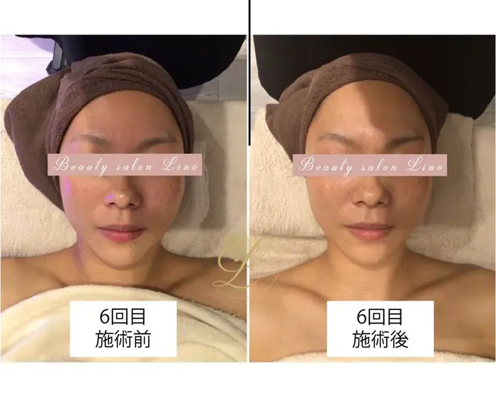 当サロンには美肌脱毛以外にも フェイシャルエステ オイルマッサージ などの Menuもございます Beauty Salon Lino所属 Lino 美肌脱毛 のエステ リラクカタログ ミニモ