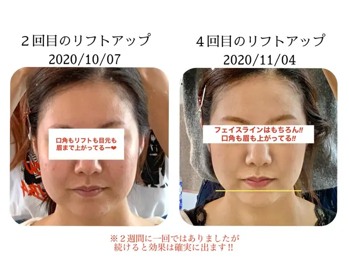 美肌のツボとリフトアップのツボ押しを ２週間毎に貼り替えでご来店 こんなにも変わります Setsalon Churaku所属 浜比嘉 綾のヘアカタログ ミニモ