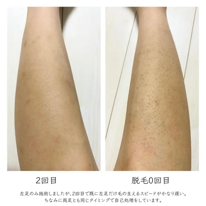 脱毛2回目です Marunouchi Salon所属 加藤 巳和のエステ リラクカタログ ミニモ