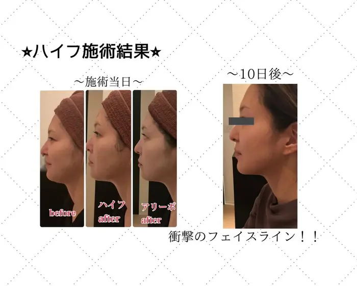 スポット超音波を当てた後 美顔器を行うことでさらに小顔効果up しっかり顎と首の境目が見えてきま My Art所属 藤本 佳奈美のエステ リラクカタログ ミニモ