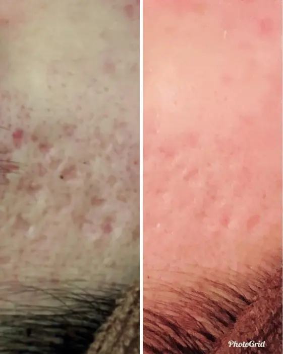 ニキビ跡も諦めないで ニキビは根強いものですので多少時間はかかります でもこれだけ綺麗になりま ハーブ専門dioneさいたま店所属 佐藤 えみのエステ リラクカタログ ミニモ