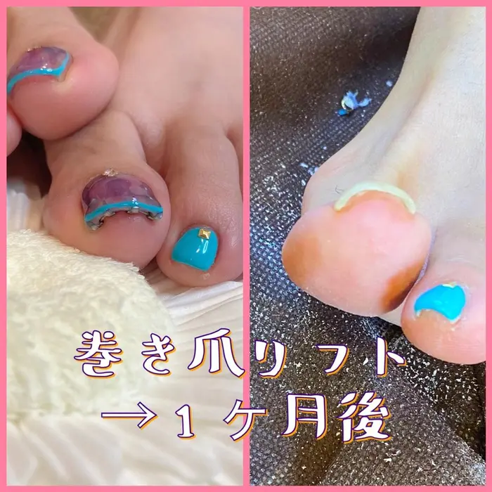 巻き爪 京都初 巻き爪リフト 爪トラブル 痛み解放 ジェルネイルもできる 巻き爪ジェルネイル Magenta所属 Mgenta Nail 巻き爪の ネイルデザイン ミニモ