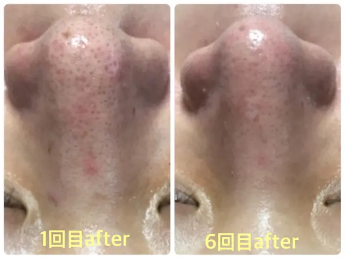 毛穴がお悩みのお客様 毛穴とっても小さくなりました 食事にも気を付けていて 努力が見られます ハーブ専門dioneさいたま店所属 佐藤 えみのエステ リラクカタログ ミニモ