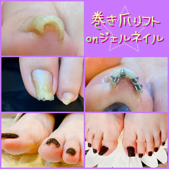 巻き爪 京都初 巻き爪リフト 爪トラブル 痛み解放 ジェルネイルもできる 巻き爪ジェルネイル Magenta所属 Mgenta Nail 巻き爪の ネイルデザイン ミニモ
